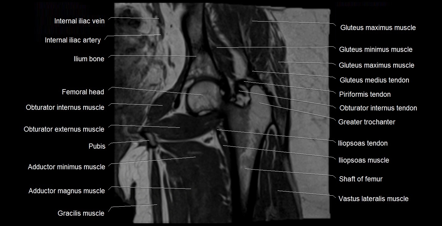MRI Hip 3T coronal cross sectional anatomy image 36.webp
